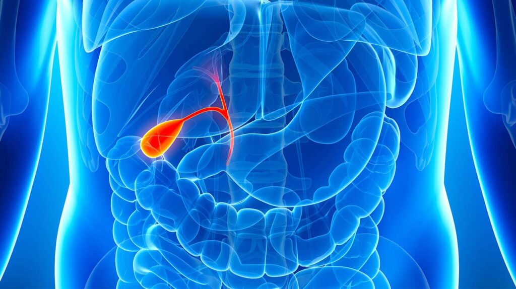 calculs vésicule biliaire