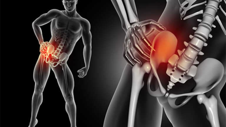 Combien de temps dure le syndrome du piriforme